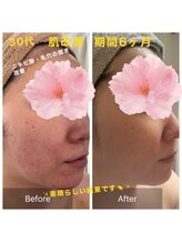 クリニカルエステ(Salon de LOMA reve beaute)/ドクターリセラ素肌改善☆