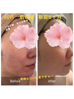 クリニカルエステ(Salon de LOMA reve beaute)/ドクターリセラ素肌改善☆