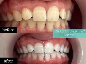ホワイトニングカフェ 博多駅前店(WhiteningCafe)/◎歯のホワイトニング施術写真◎