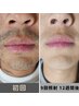 【ヒゲ特化型脱毛】ヒゲセット（全部位）青ひげ撃退¥11,000→¥1,100  回数1回