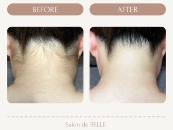 サロンドベル(Salon de BELLE)/ビフォー&アフター(うなじ)