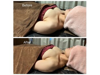 リノレア(LinoLea)/バストアップBefore after