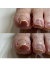 リリ(lili)/巻き爪矯正1回目（左親指）