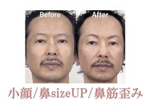 ラプリボヤージュ 藤沢店(Raplit)/ 隆鼻＋輪郭矯正40分20回