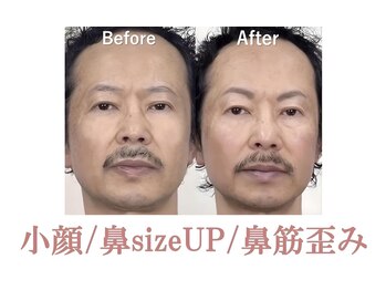 ラプリボヤージュ 藤沢店(Raplit)/ 隆鼻＋輪郭矯正40分20回