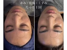 オーシャンブルーム 目黒(OceanBloom)/赤み/ごわつき/くすみ