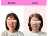 【新規◇11月限定】歪みレス小顔矯正(左右差/歪み/エラ) ¥6,600→¥5,500