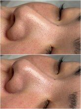 レアリゼ(REALISER)/ハイドラ毛穴洗浄