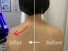 ミスティア(mistia)/エステ【首・肩】1回/After