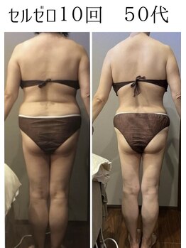 ムーン 高崎店(MOON)/痩身エステ50代