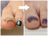 【オフケア込み】足裏角質ケアとセットでお得◎巻き爪でお悩みの方　13,200→
