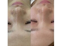 ファーファラ(Farfalla)の雰囲気(1度で改善◎最新シミケアWHITE)