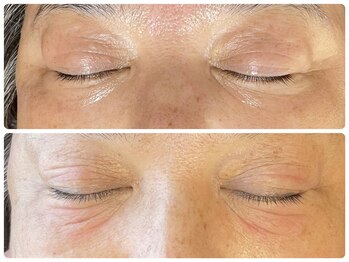 ラヴィ(Ravi)/大人の目元はトラブルだらけ