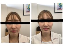 田端整体院/小顔整体の施術前後の写真