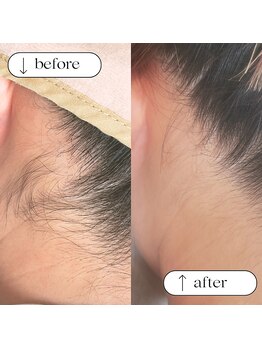 ドゥ(doux)/うなじ脱毛で後姿美人♪