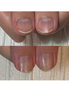 キュア(Cure.)/親指を美しく育てる自爪育成