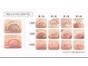 【50%OFF！】ジェルで痛みのない巻き爪矯正60分/1本¥3300→¥1650
