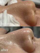 ユウユウ(YUYU)/毛穴洗浄＋WAX