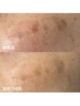 サロンドベルム(Salon de BELME)/シミケア経過：施術7回後