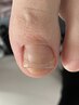 テープタイプの巻き爪矯正★爪1本 約45分+他の爪ケアサービス