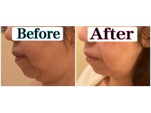 トータルビューティーサロン 凛/二重アゴをなんとかしたい！