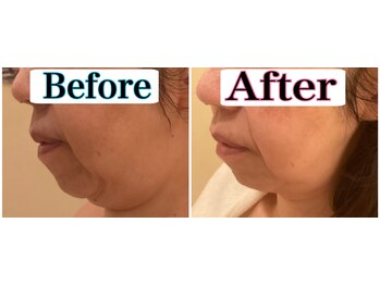 トータルビューティーサロン 凛/二重アゴをなんとかしたい!