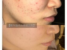 ル シーニュ/プロセルフェイシャル×4回