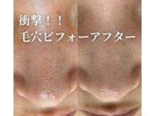 ウェルビーイング(well-being)/何をしても消えない毛穴へ