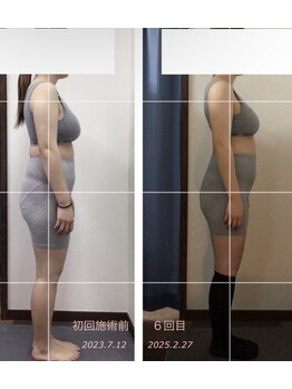 サロン ナウ オア ネバー(Salon Now or Never)/気象からの頭痛、食いしばりも