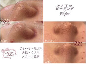 メゾンリュバン 梅田店(Maison Ruban)/毛穴洗浄・美白フォト|毛穴ケア