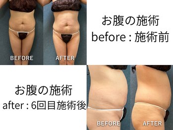 ビーホープ(B.hope)の写真/ぽっこりお腹を卒業！40代から始める理想のウエストづくり。何をしても痩せないお腹に、本気のサイズダウン