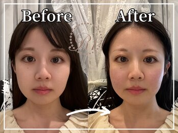 R-1ビューティーサロン 銀座/BEFORE＆AFTER