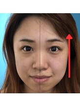 ネクスフィット(Nexfit)/小顔矯正フェイスリフトの効果