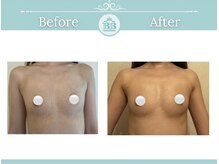 美人バスト 静岡店/バストアップ症例