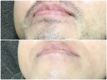 カルム(Calme)/ヒゲ脱毛 30代