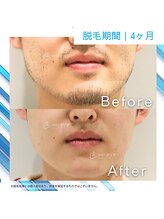 メンズクリア 広島店/【メンズクリア】お客様の施術例