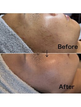 ブルームーン(Blue Moon)/REVIハーブピーリング 2回