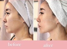 エピリス(Epiliss)