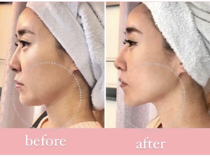 エピリス(Epiliss)の写真