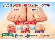 巻き爪じゅん 船橋店/爪の形が左右で違う人は要注意！