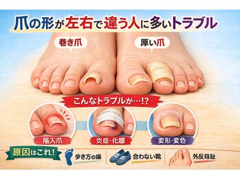 巻き爪じゅん 船橋店/爪の形が左右で違う人は要注意!