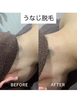 ヴィヴ 三島店(Vive)/《うなじ脱毛》