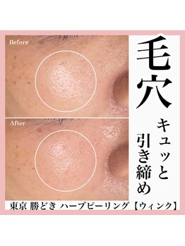 ウィンク 勝どき(wink)/ハーブピーリング