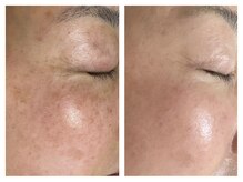 エフ(f)/プラズマでシミ改善とシワ改善