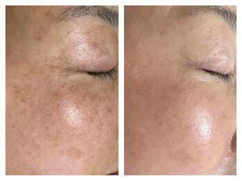 エフ(f)/プラズマでシミ改善とシワ改善