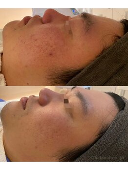 カランコエ(KALANCHOE)/長年悩みのニキビケア