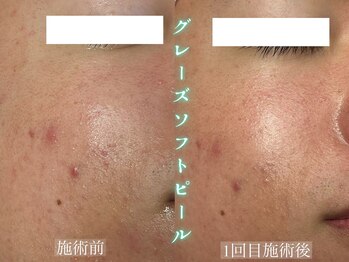 スイッチプラス(switch+)/男性の肌荒れに