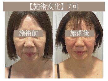 ドクターボディ 恵比寿店(Dr.Body)/【頬のたるみ/ほうれい線 60代】