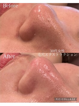 ウォーム(Warm)/30代　毛穴エクストラクション