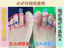 ニコ(niko)/かがみ指改善例